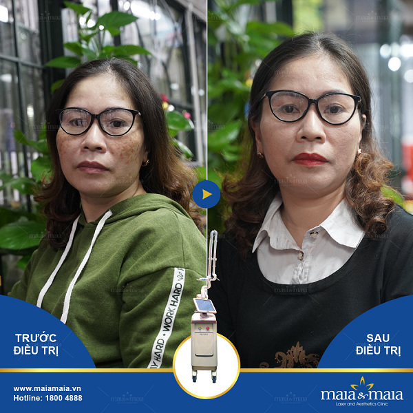 Cải thiện da nám, lão hóa bằng công nghệ đa trị liệu tại phòng khám Maia