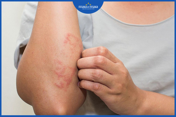 Da bị khô do nguyên nhân gì? Có phải là bệnh không? 3 Một số bệnh da liễu có thể khiến da bị khô và ngứa
