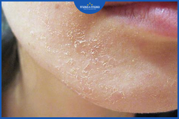 Da bị khô do nguyên nhân gì? Có phải là bệnh không? 2 Làn da bị bong tróc, thô ráp