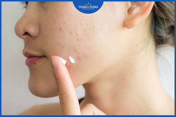 Làm cách nào để kiểm soát dầu trên da? 5 Thuốc bôi là một phương pháp để kiểm soát dầu trên da