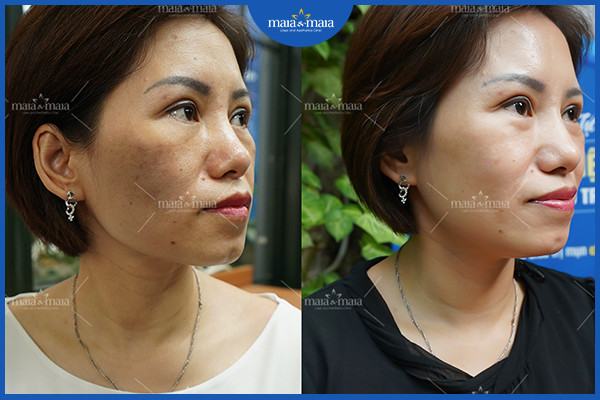 Chăm sóc da bằng thuốc kê đơn cần lưu ý những gì? 4 Hiệu quả điều trị nám đa trị liệu tại phòng khám Maia