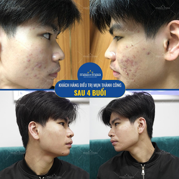 Công dụng của laser trong điều trị, chăm sóc da 11 Hỗ trợ điều trị mụn trứng cá và thâm mụn