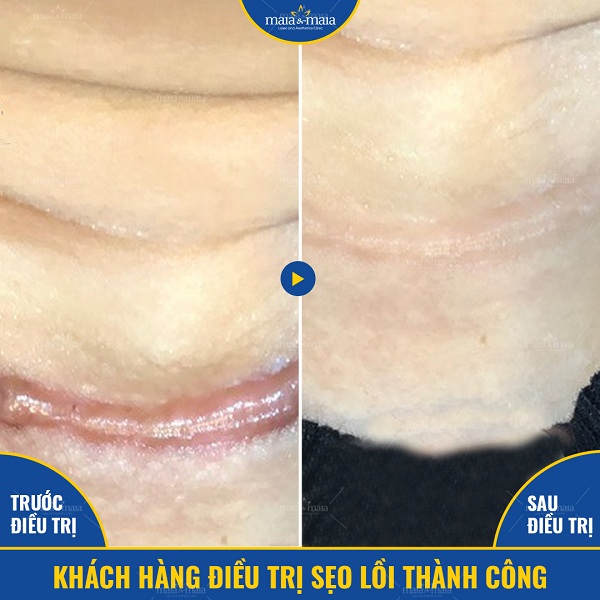 Công dụng của laser trong điều trị, chăm sóc da 10 Hỗ trợ điều trị sẹo lồi