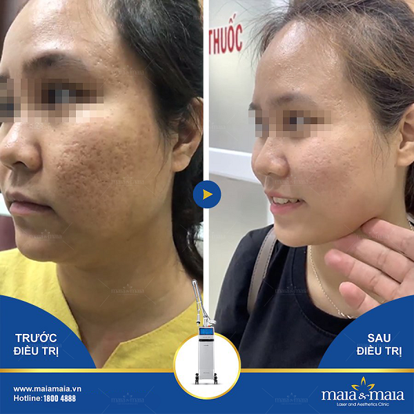 Công dụng của laser trong điều trị, chăm sóc da 9 Hỗ trợ điều trị sẹo lõm