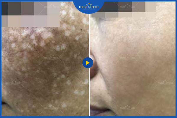 Công dụng của laser trong điều trị, chăm sóc da 2 Hiệu quả của sử dụng laser trong điều trị sắc tố