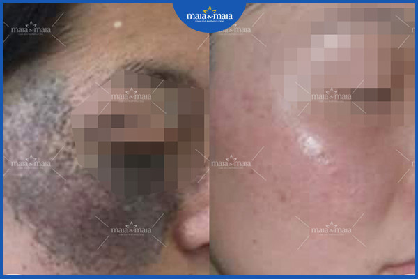 Công dụng của laser trong điều trị, chăm sóc da 7 Hỗ trợ điều trị bớt sắc tố