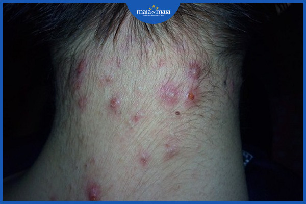 Mụn vùng cổ và phương pháp điều trị 3 Mụn viêm ở vùng gáy