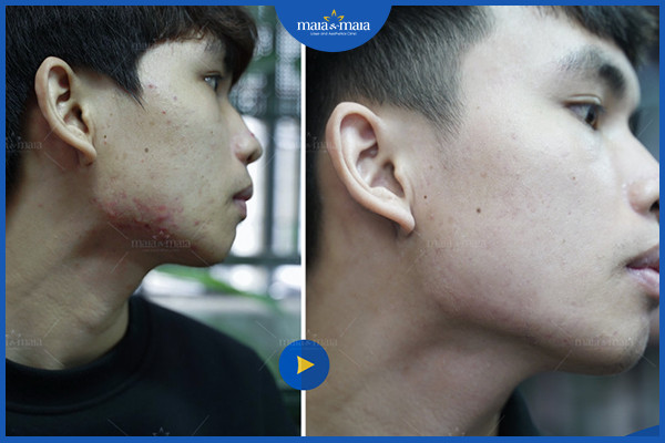 Mụn vùng cổ và phương pháp điều trị 6 Hiệu quả điều tị mụn tại phòng khám