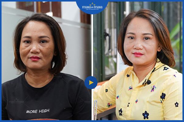 So sánh hai phương pháp thẩm mỹ: Peel da và tái tạo bề mặt da bằng laser 3 Hiệu quả của laser trong điều trị nám da