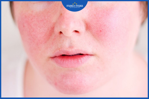 So sánh hai phương pháp thẩm mỹ: Peel da và tái tạo bề mặt da bằng laser 4 Cả hai phương pháp thẩm mỹ này đều có thể gây ra các tác dụng phụ