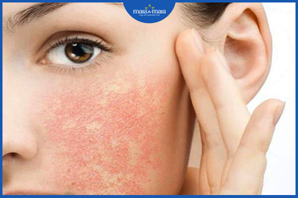Là da bị tổn thương do tẩy tế bào chết không đúng cách