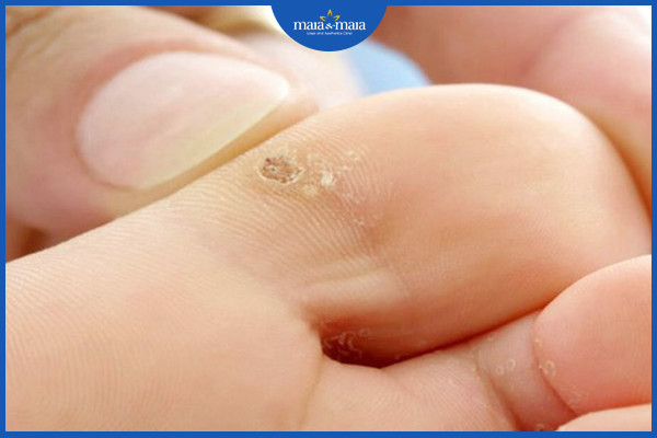 Điều trị mụn cóc và những điều cần biết 3 Mụn cóc ở lòng bàn chân
