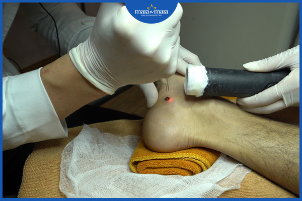 Điều trị mụn cóc và những điều cần biết 7 Điều trị mụn cóc bằng laser tại phòng khám maia