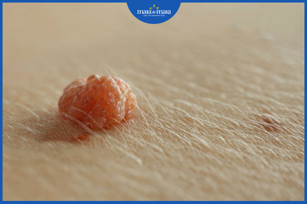 Điều trị mụn cóc và những điều cần biết 4 Mụn cóc dạng sợi