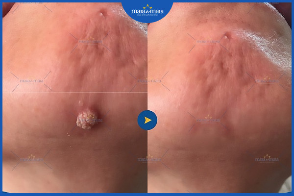 Điều trị mụn cóc và những điều cần biết 2 Mụn cóc có hình dạng như súp lơ thu nhỏ