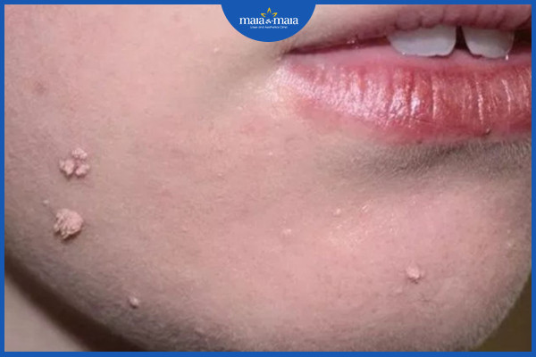 Điều trị mụn cóc và những điều cần biết 5 Mụn cóc dạng sợi ở vùng mặt