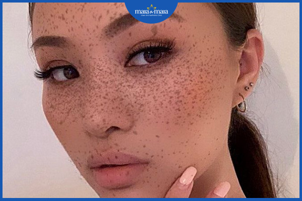 Tăng sắc tố trên da do ánh nắng mặt trời - Nhận biết và cách điều trị 3 Tàn nhang thường gặp ở những người da trắng