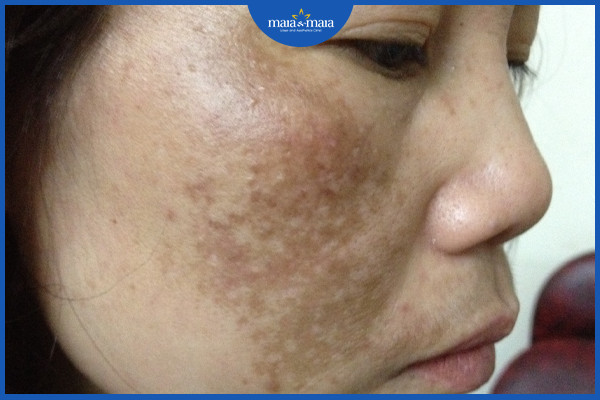 Tăng sắc tố trên da do ánh nắng mặt trời - Nhận biết và cách điều trị 2 Nám da là một tình trạng tăng sắc tố trên da do ánh nắng mặt trời