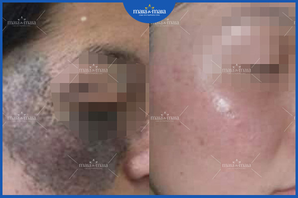 Tăng sắc tố trên da do ánh nắng mặt trời - Nhận biết và cách điều trị 7 Hiệu quả điều trị bớt sắc tố tại phòng khám Maia