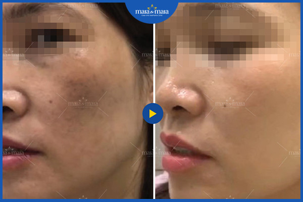 Cách cải thiện làn da không đều màu tại nhà 6 Hiệu quả cải thiện nám da, làm đều màu da tại phòng khám Maia