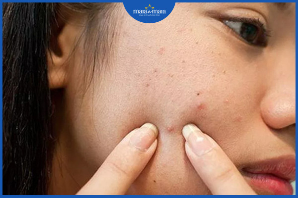 Những hậu quả khi điều trị mụn sai cách 2 Không nên nặn mụn bằng tay, tránh việc mụn tiến triển nặng hơn