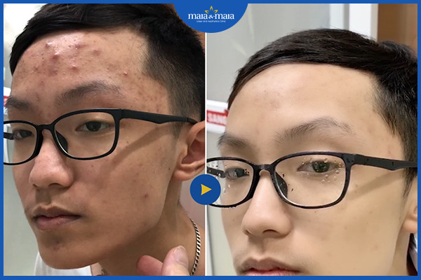 Những hậu quả khi điều trị mụn sai cách 7 Hiệu quả điều trị mụn chuẩn y khoa tại phòng khám Maia
