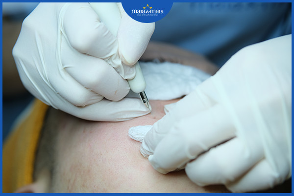Những hậu quả khi điều trị mụn sai cách 6 Loại bỏ nhân mụn bằng Laser diot tại phòng khám Maia