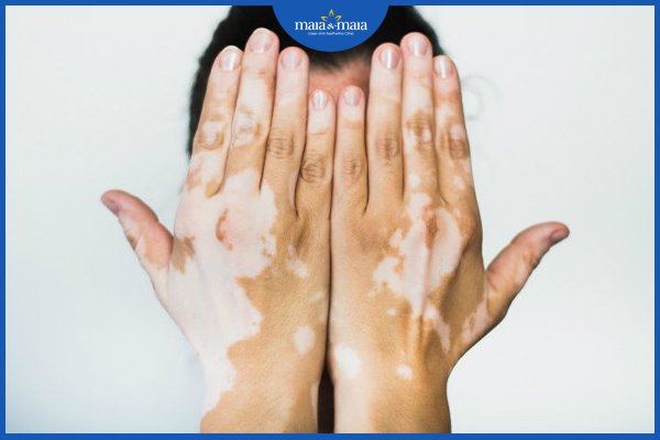 Bạch biến có chữa được không? Điều trị như nào? 2 bạch biến có chữa được không