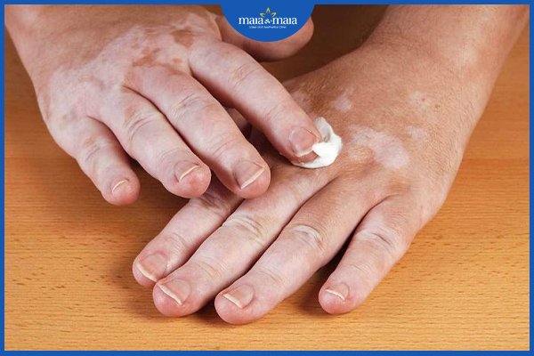 Bạch biến có chữa được không? Điều trị như nào? 3 bạch biến