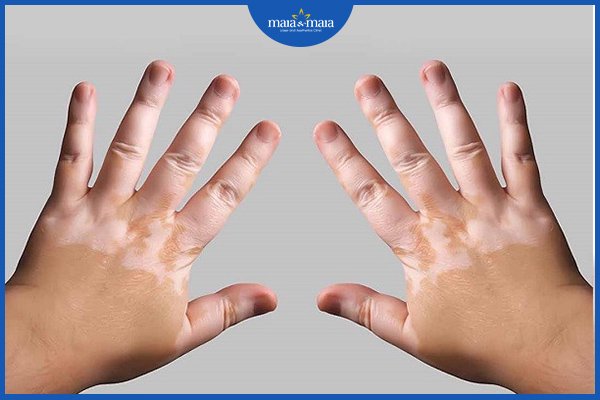 Bạch biến có lây không? 3 bạch biến