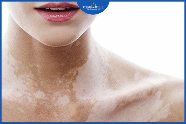 Bạch biến có lây không? 2 bạch biến có lây không