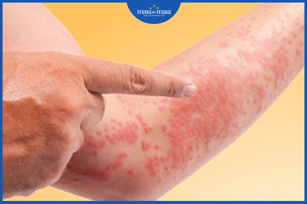 Dấu hiệu dị ứng bia 2 dấu hiệu dị ứng bia