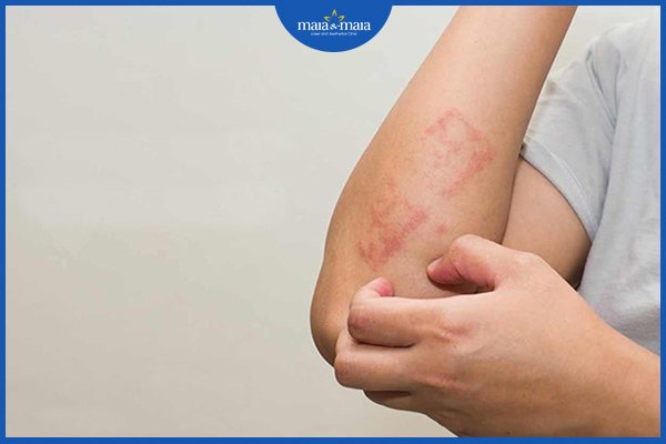 Dị ứng có di truyền không? 2 dị ứng có di truyền không