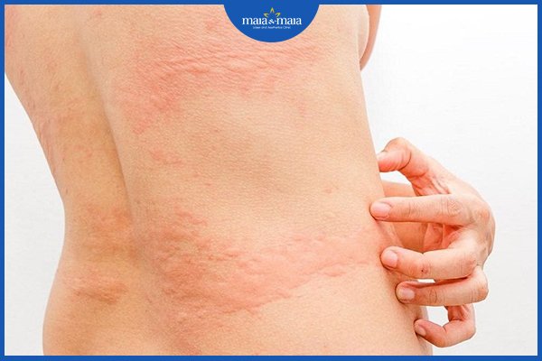 Dị ứng có di truyền không? 3 nổi mề đay
