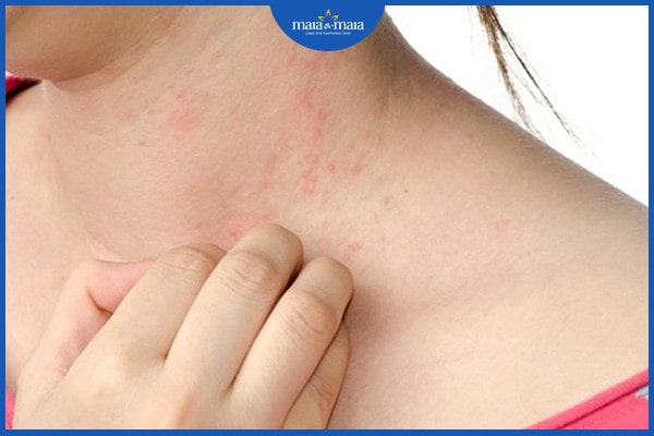 Dị ứng thực phẩm và cách điều trị 2 dị ứng thực phẩm và cách điều trị