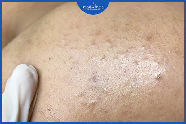 Làm thế nào để loại bỏ mụn đầu đen? 4 Mụn đầu đen ở vùng má do bít tắc nang lông