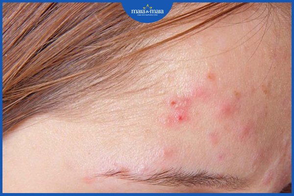 Mụn bọc ở trán: nguyên nhân và cách điều trị như nào? 2 mụn bọc ở trán