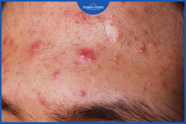 Mụn bọc ở trán: nguyên nhân và cách điều trị như nào? 3 mụn bọc