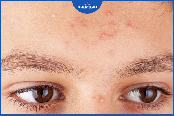 Mụn bọc ở trán: nguyên nhân và cách điều trị như nào? 4 mụn bọc trên trán