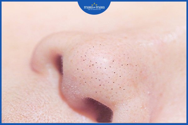 Mụn đầu đen và mụn đầu trắng khác nhau như nào? 2 mụn đầu đen và mụn đầu trắng