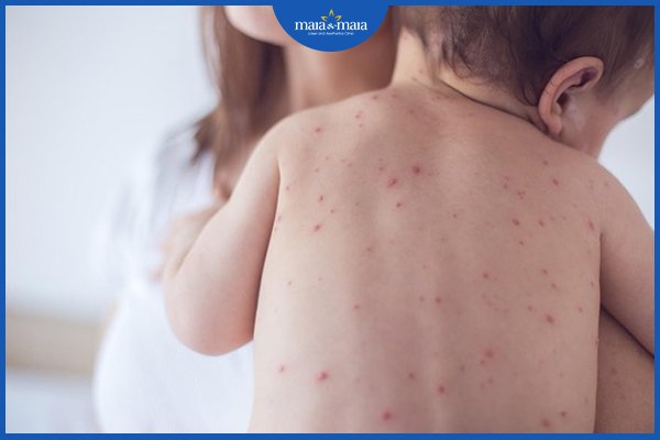 thủy đậu dễ ​​lây nhất khi nào