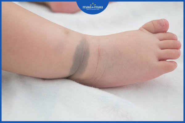 Vết bớt trên cơ thể có thực sự an toàn? Khi nào cần chú ý? 2 vết bớt trên cơ thể