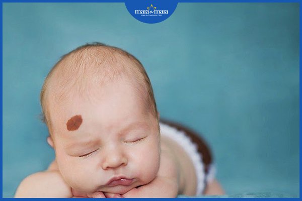 Vết bớt trên cơ thể có thực sự an toàn? Khi nào cần chú ý? 4 vết bớt trên cơ thể