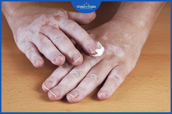 Bạch biến có di truyền không? 3 bạch biến