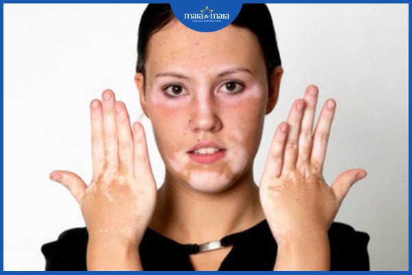 Bạch biến và bạch tạng - phân biệt để tránh nhầm lẫn! 3 bệnh bạch biến
