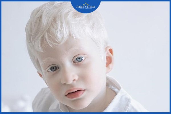 Bạch biến và bạch tạng - phân biệt để tránh nhầm lẫn! 2 bạch biến và bạch tạng