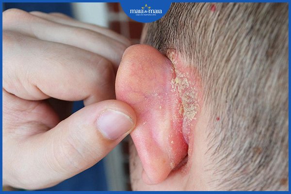Bệnh vảy nến ở mặt - biểu hiện và cách điều trị 4 vảy nến ở tai