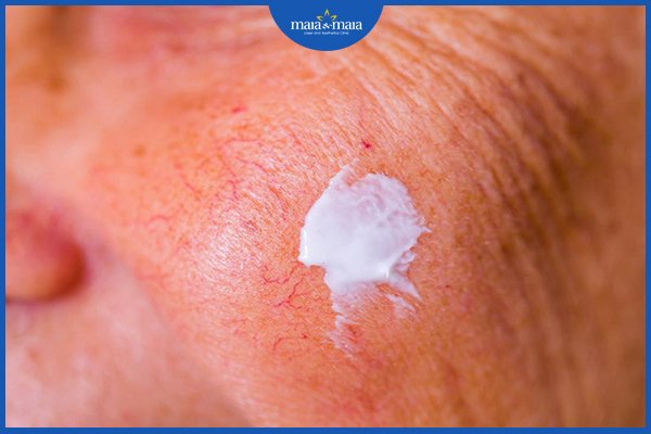 Bệnh vảy nến ở mặt - biểu hiện và cách điều trị 3 bệnh vảy nến ở mặt