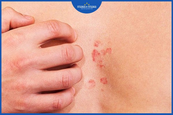 Dị ứng thời tiết có nên tắm không? Cần lưu ý những gì? 2 dị ứng thời tiết nên tắm không