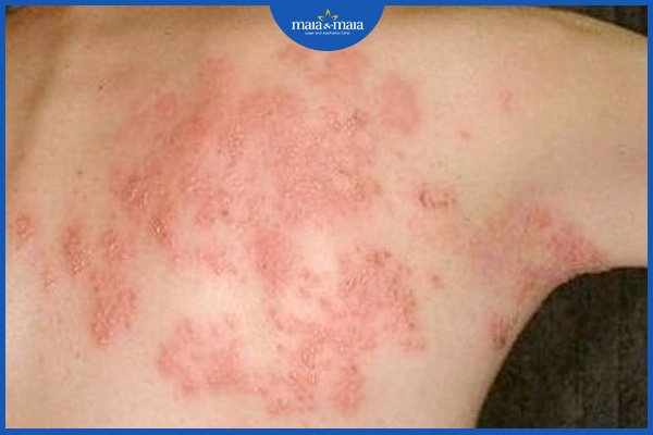 Viêm da dị ứng bội nhiễm 4 viêm da dị ứng